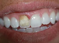Teeth Whitening and Repairs