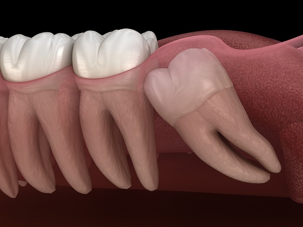 Signs To Consider Wisdom Tooth Extractions